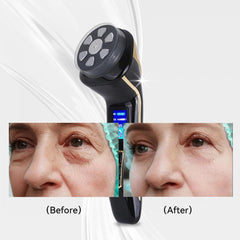 FREYARA FacialDefy 2.0 4-in-1 HIFU, RF, EMS & Pulse Facial Device
